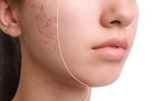 Safe Acne Treatment Tips for Clearer Skin and Lasting Confidence