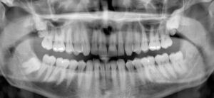 Panoramic Dental X-Ray