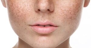 How to Choose the Best Pigmentation Treatment for Your Skin Type