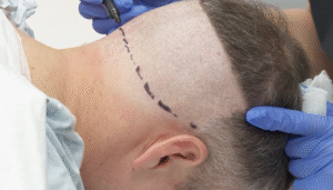 How to Get the Best Results from Your Hair Transplant Procedure