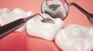 Tooth Filling Cost in Dubai