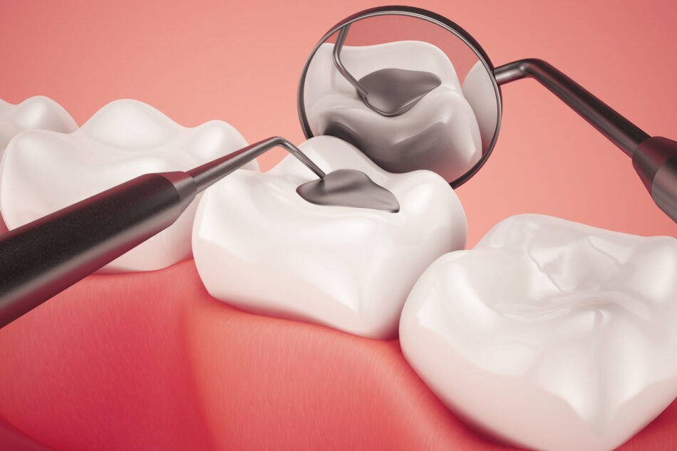 Tooth Filling Cost in Dubai