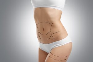 Discover the Benefits of Laser Liposuction Jeddah Today