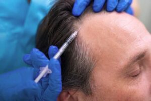 Top Clinics Offering PRP Hair Treatment Riyadh