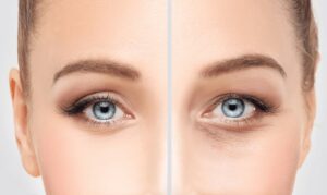 Under Eye Fillers Tips for Bright and Refreshed Eyes Instantly