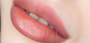 Discover Lasting Glow with Safe Pink Lips Laser Treatment Results