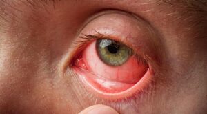 Doctor at Home for Eye Infections: What to Expect