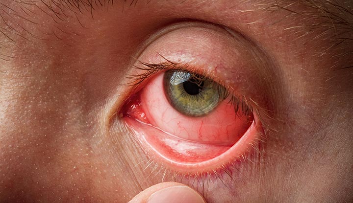 Doctor at Home for Eye Infections: What to Expect