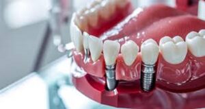 Affordable Dental Implants in Dubai for All Budgets