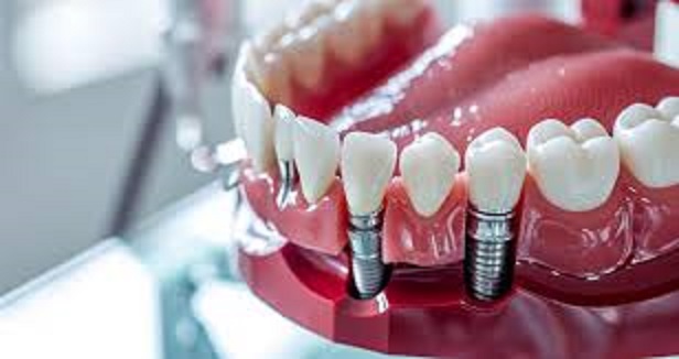 Affordable Dental Implants in Dubai for All Budgets