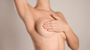 Breast Augmentation in Dubai