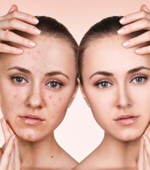 Can Acne Treatment in Dubai Reduce Redness and Inflammation Quickly?
