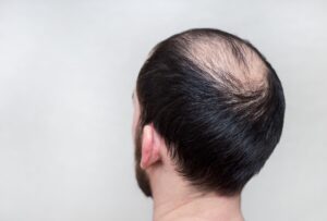 Can G Cell Hair Treatment Help Men With Bald Spots?