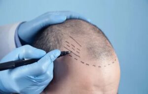 Can I get a hair transplant with diffuse thinning?