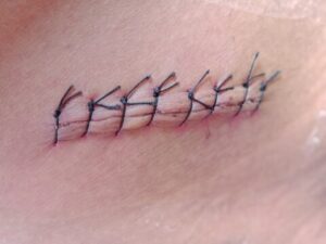 Can Improper Stitches Removal at Home in Dubai Cause Permanent Damage?