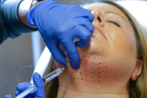 Can Kybella Remove Stubborn Fat Under the Chin?