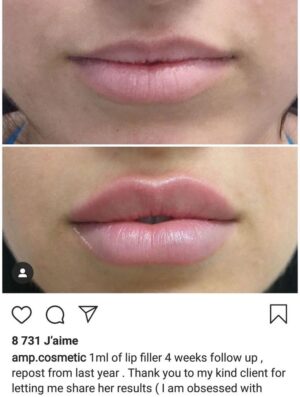 Can Lip Filler Injections in Dubai Correct a Thin Upper Lip?