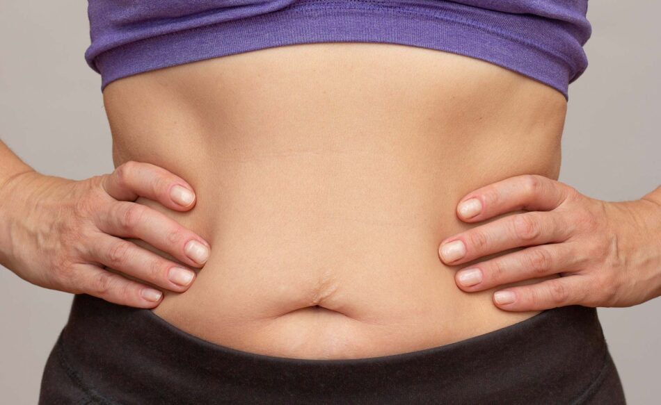 Can a Tummy Tuck Address Hanging Skin Folds?
