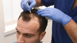 Can stem cell hair transplantation treat genetic baldness effectively?
