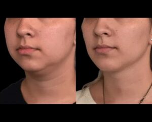 Choosing the Right Anesthesia with the Best Double chin removal Surgeons in Dubai