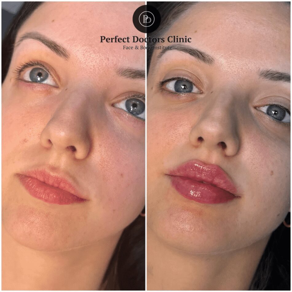 Juvederm for Temple Volume at the Best Aesthetic Clinic in Dubai