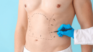 Do Men Also Benefit from Having Liposuction Surgery?