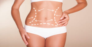 Does Abdominal Liposuction in Dubai Help With Cellulite or Loose Skin?