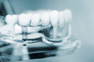 Experienced Dental Implant Surgeons for Perfect Smiles