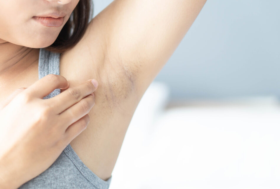 Expert Tips for Chemical Peeling Underarms