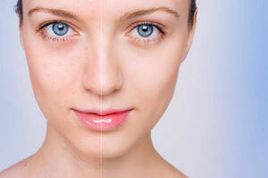 The Psychological Benefits of Choosing Facelift Surgery