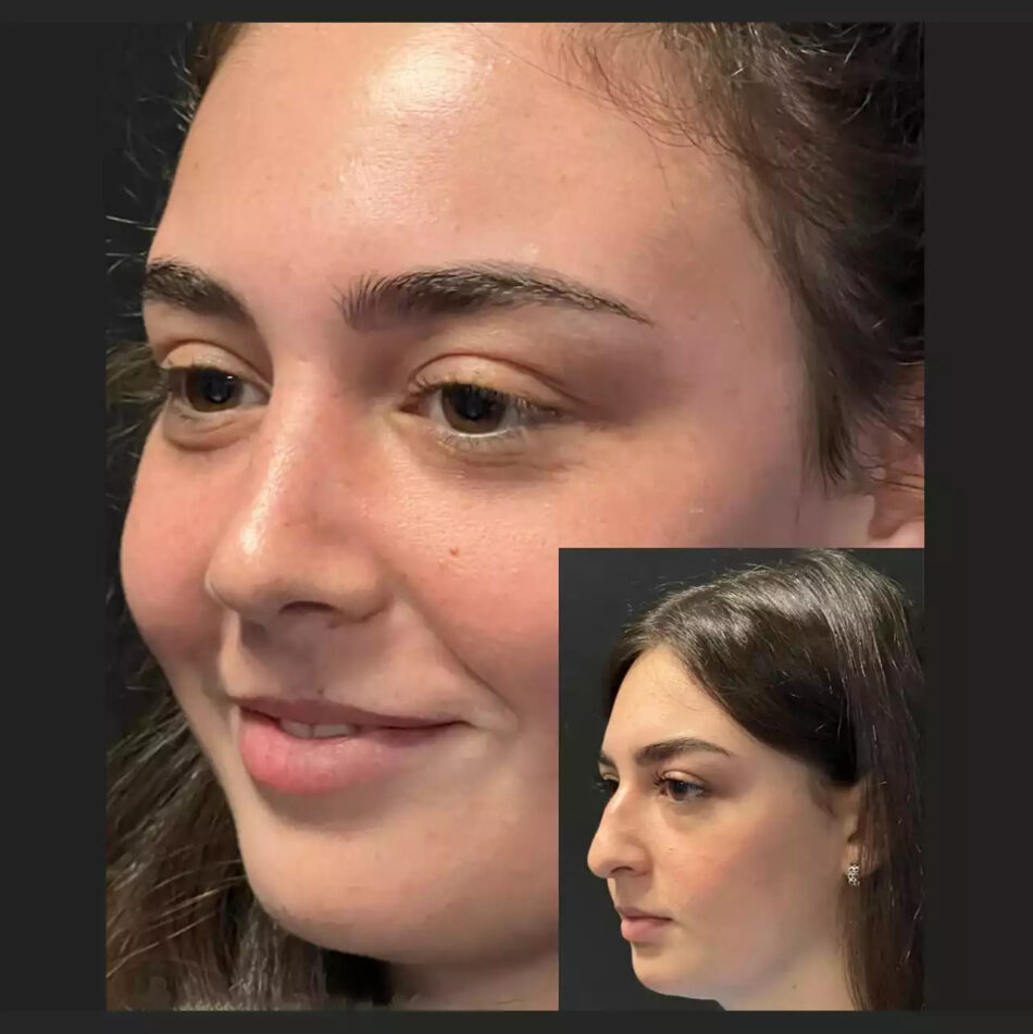 Choosing the Best Rhinoplasty Surgeons in Dubai for Cosmetic Excellence