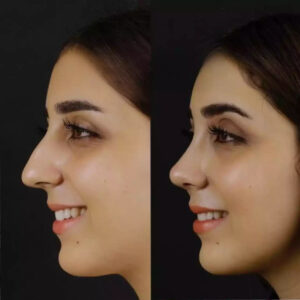 Evaluating the Best Septoplasty Surgeons in Dubai: Key Factors