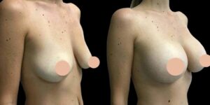 A Complete Guide to Consultation with the Best breast augmentation Surgeon in Dubai