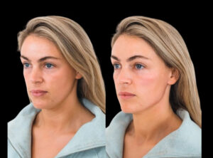Why is the Best Destination for Cheek Fillers Treatments in Dubai