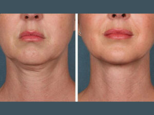 Best Plastic Surgeons in Dubai PRP Treatment for Under-Eye Rejuvenation