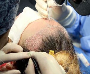 Top Tips for Hair Transplant in Riyadh