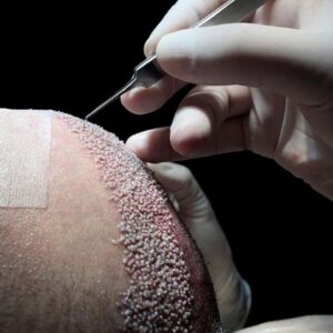 Effective Hair Regrowth Riyadh