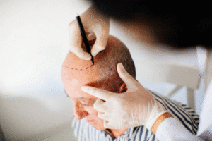 Hair Transplant in Riyadh: Understanding the Procedure Step-by-Step