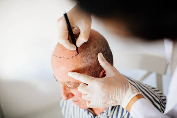 Hair Transplant in Riyadh: Understanding the Procedure Step-by-Step