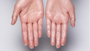 How Effective Is Hyperhidrosis Treatment for Sweaty Palms?