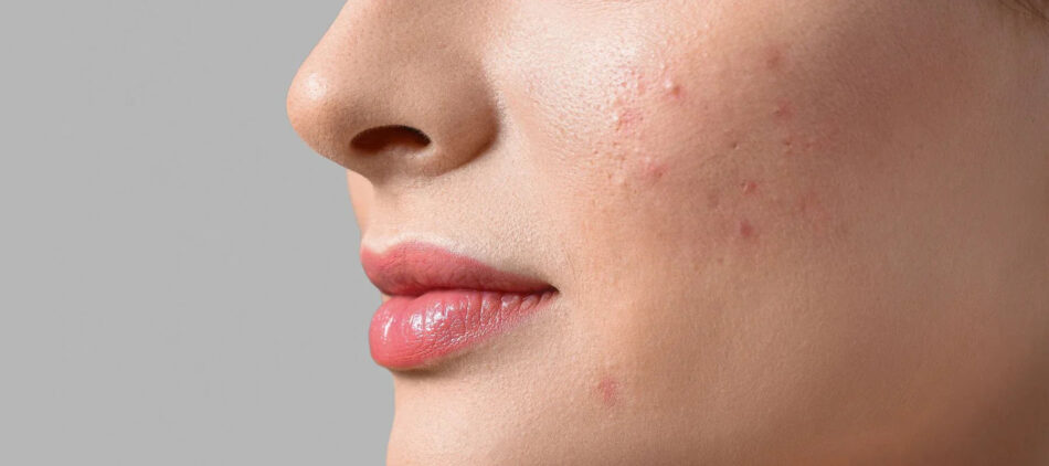 Clear and Healthy Skin Fast with Proven Acne Treatment