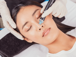 Is Hydrafacial Effective for Oily and Acne-Prone Skin?