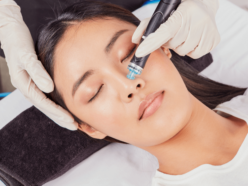 Is Hydrafacial Effective for Oily and Acne-Prone Skin?