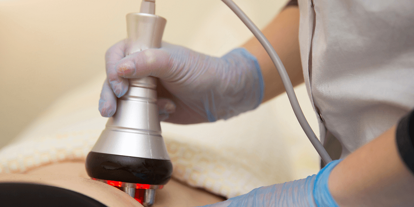 Laser Liposuction Treatment: Steps and Preparation