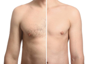 Laser hair removal for sensitive areas for men in Dubai