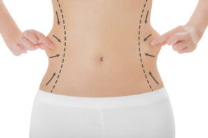 How Nutrition Influences Healing After Lipo Abdominoplasty Surgery