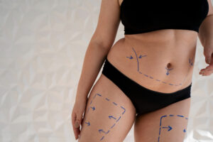 Liposuction in Dubai: Is It the Right Procedure for You?