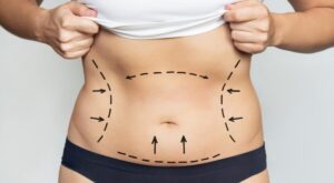 Liposuction in Dubai