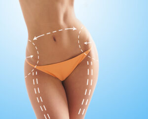 Preparing for Liposuction Surgery in Riyadh