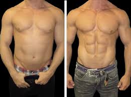 Common Questions About Liposuction Surgery in Dubai Answered Here